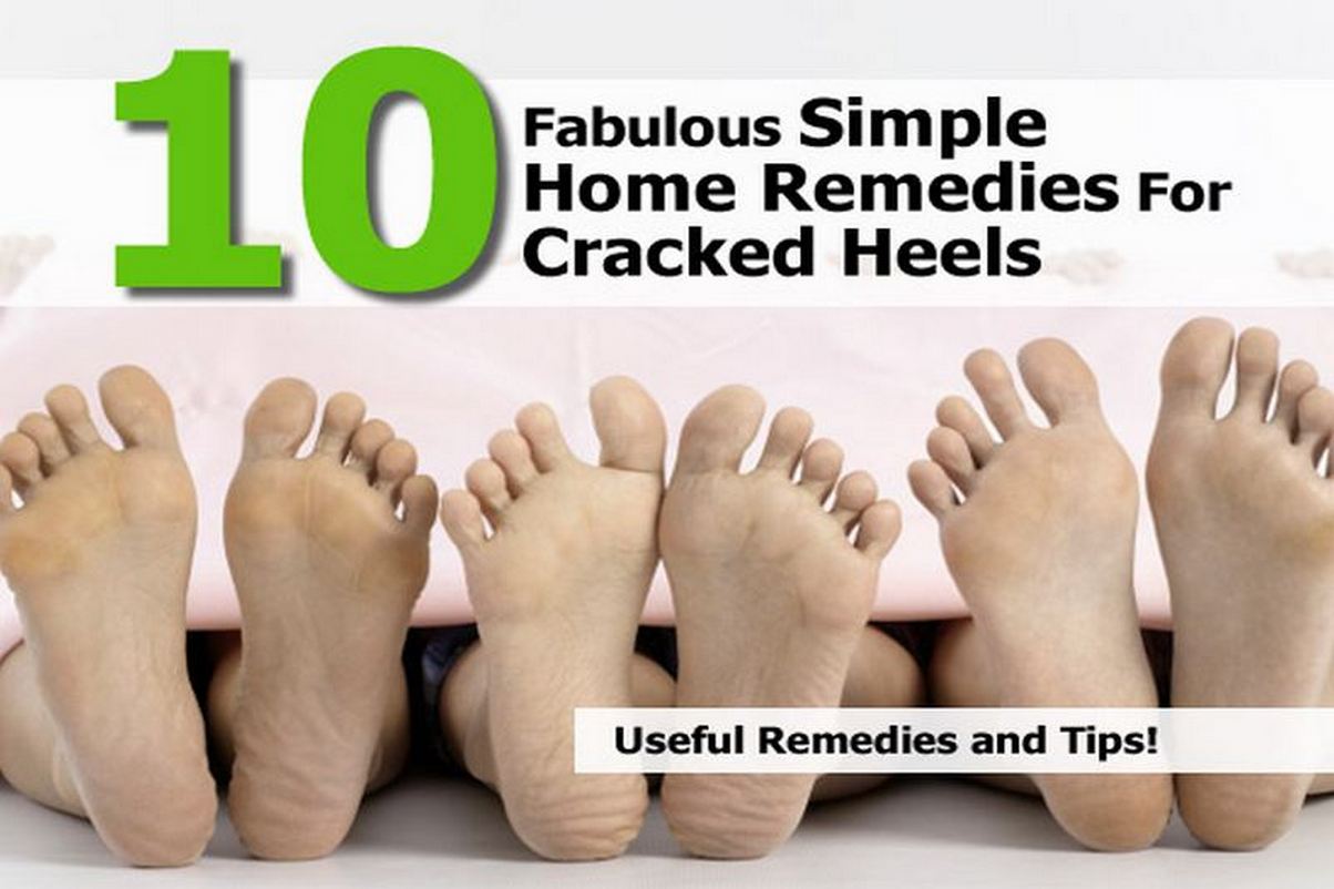 10 Fabulous Simple Home Remedies For Cracked Heels