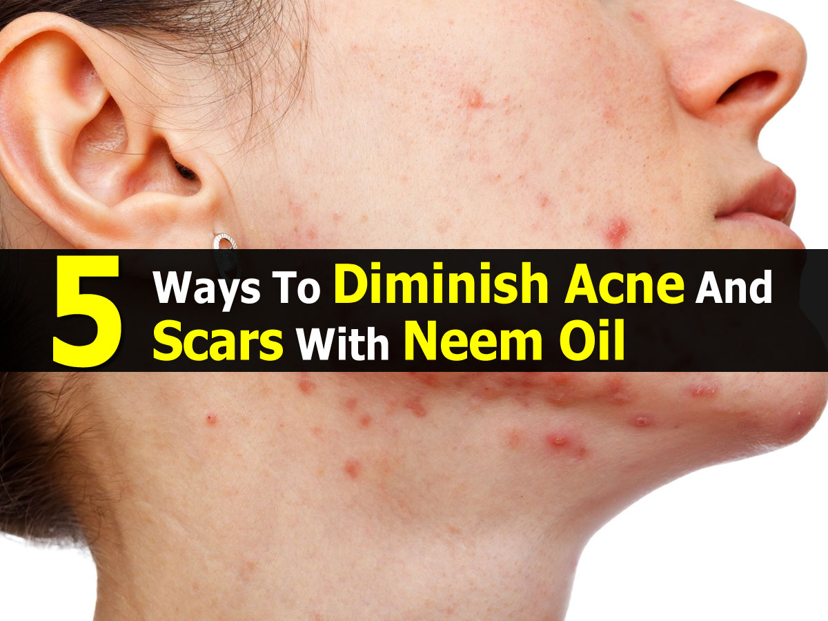 5 Ways To Diminish Acne And Scars With Neem Oil