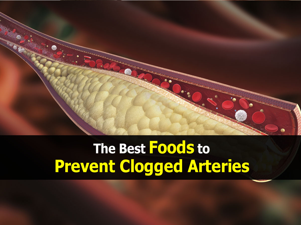 The Best Foods to Prevent Clogged Arteries