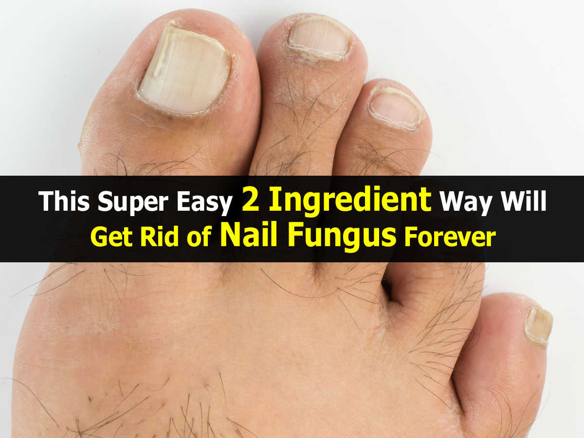 this-super-easy-2-ingredient-way-will-get-rid-of-nail-fungus-forever