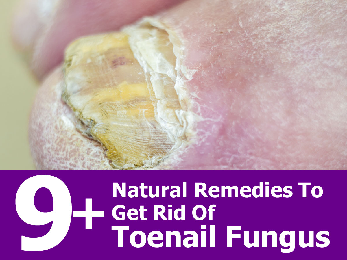 How Do You Get Rid Of Toenail Fungus