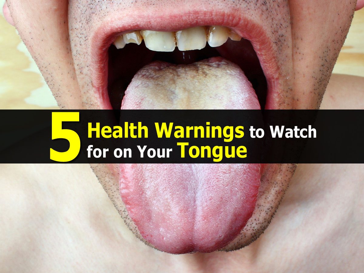 5 Health Warnings to Watch for on Your Tongue