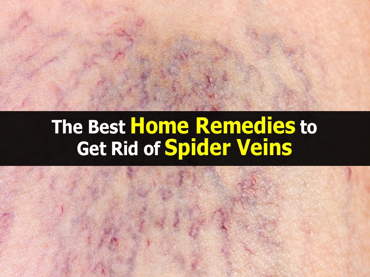 The Best Home Remedies to Get Rid of Spider Veins