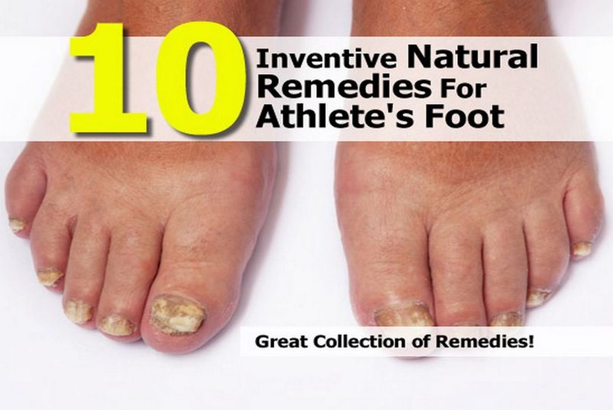 Athletes Foot Natural Cure Athletes Foot Natural Cure