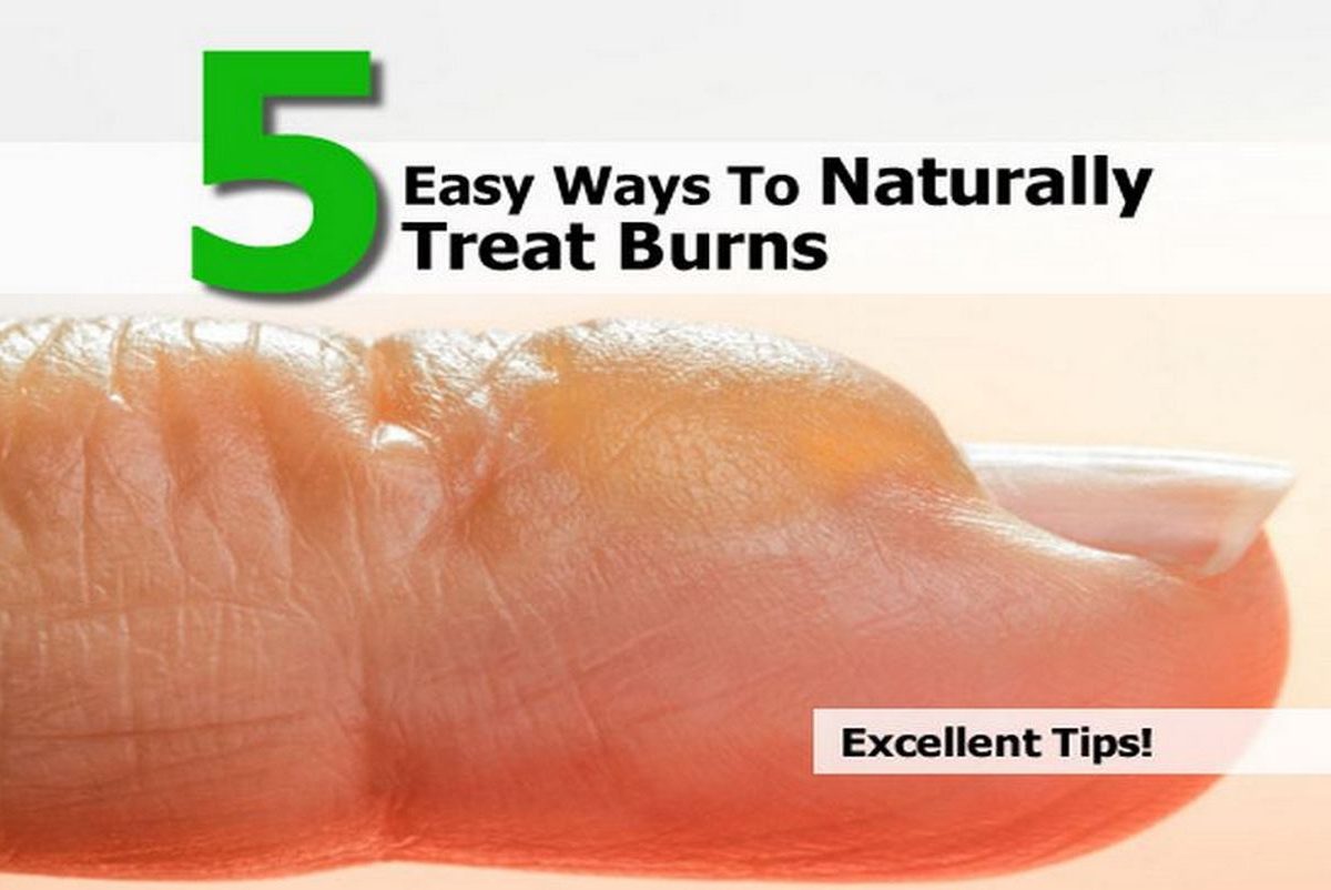 5 Easy Ways To Naturally Treat Burns