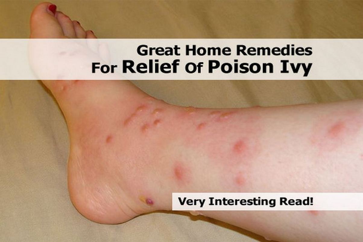 Great Home Remedies For Relief Of Poison Ivy
