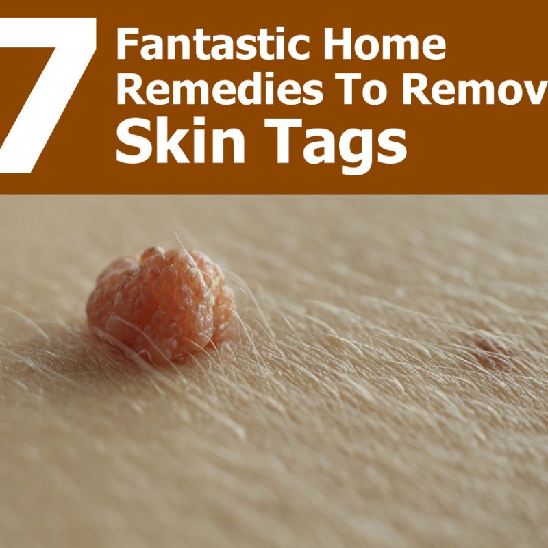 How To Safely Remove Skin Tags With Home Remedies