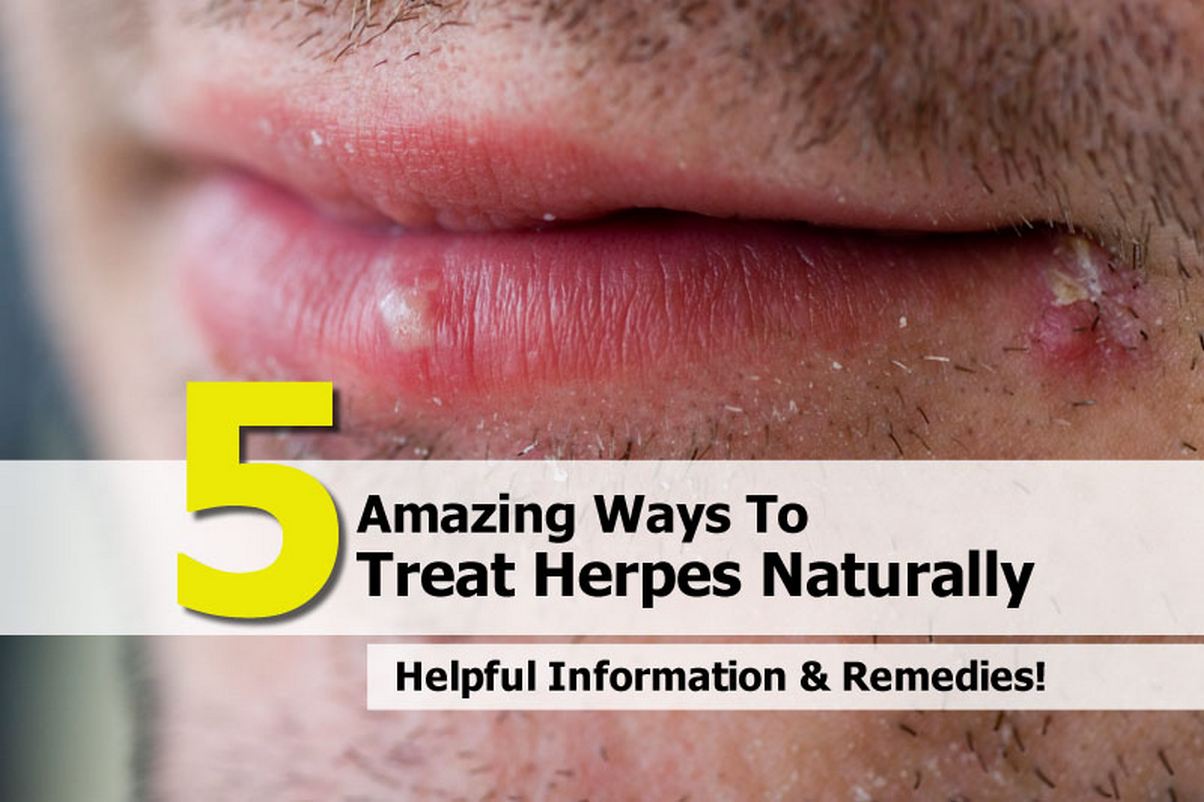 what-are-the-treatments-for-herpes-outbreaks