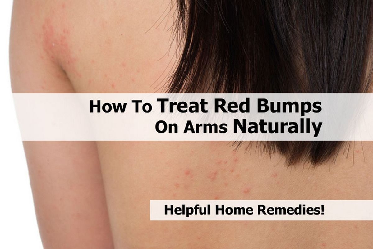 How To Treat Red Bumps On Arms Naturally